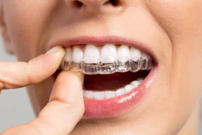 How does invisalign work